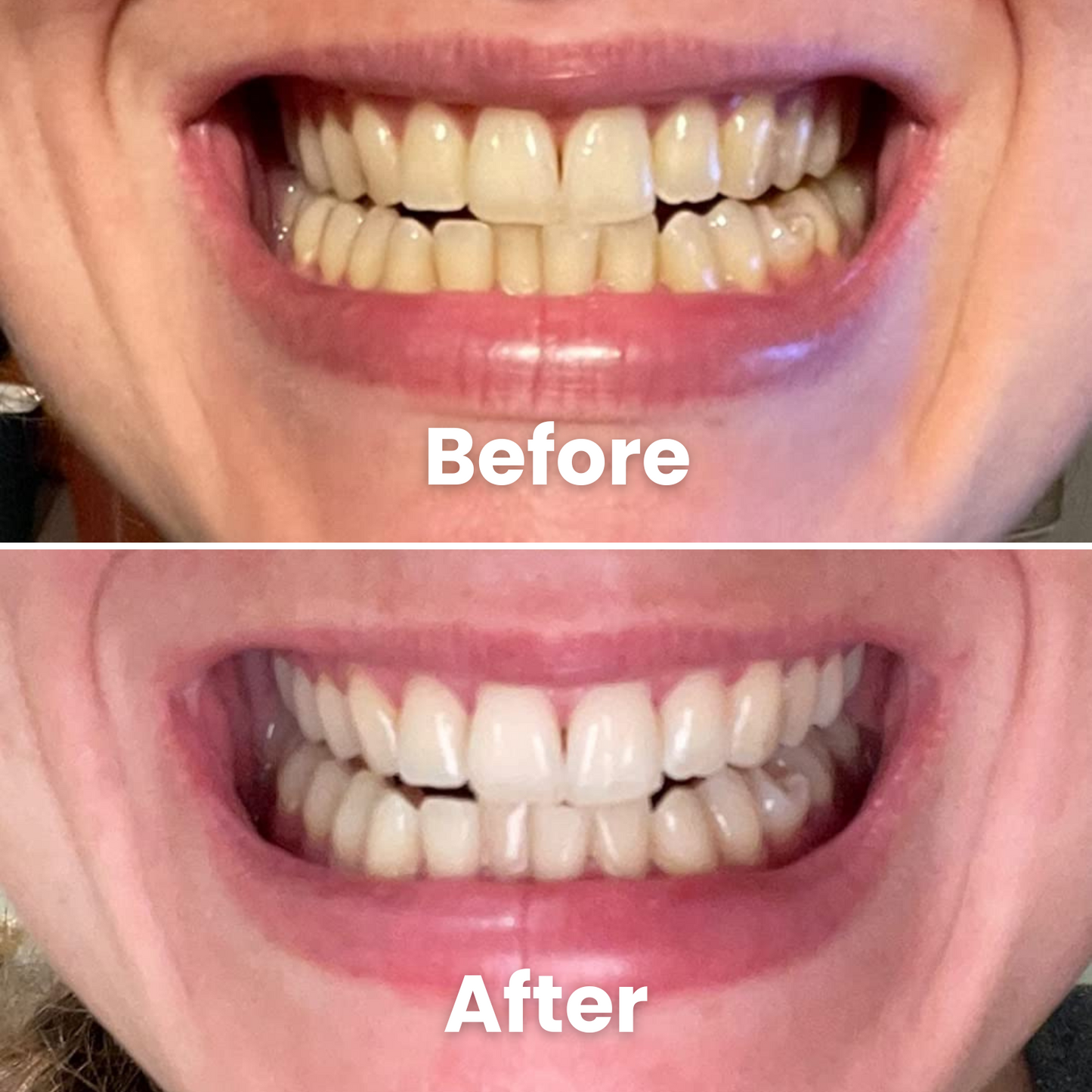 Bevalora™ Smiles Teeth Brightening Powder