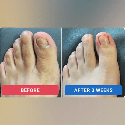 Bevalora® Parches para la Renovación de Uñas con Hongos